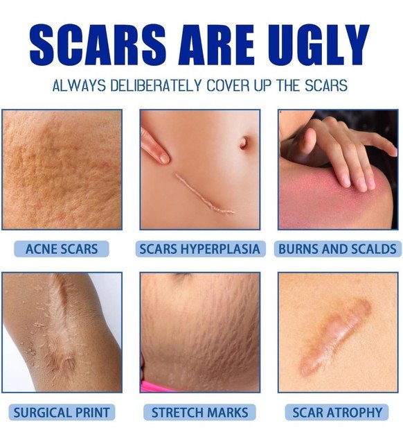 pid 67816 plastic scar removal cream white blue 5.jpg pid 67816 plastic scar removal cream white blue 5.jpg
